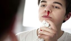 چه زمانی خون دماغ شدن خطرناکه؟ + روش بند آمدن