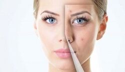 اگه جای جوش و لک داری حتما ببین! | پاکسازی صورت با روش های خانگی + فیلم