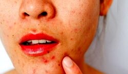 با جوش بعد از خوردن آجیل چیکار کنیم؟ | درمان فوری جوش به روش خانگی