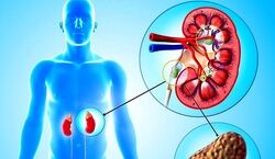 قاتل سنگ کلیه را بشناسید + توضیحات