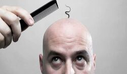 اگه این قسمت از موهات میریزه؛ قراره سکته کنی!!! | عوارض جدی ریزش مو 