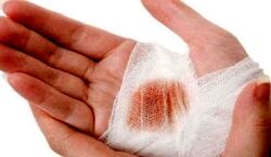 بهترین روش خانگی برای بند اومدن خونریزی زخم