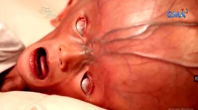 (ویدیو) تولد نوزاد عجیبی که بزرگترین سر دنیا رو داره + عکس