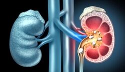 هندوانه پخته، معجزه ای برای سنگ کلیه! 