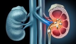 هندوانه پخته، معجزه ای برای سنگ کلیه! 