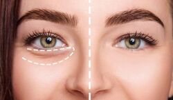 اول صبح چشام پف می کنه، چیکار کنم؟ | علت و ترفندهای خانگی رفع پف چشم