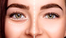 اول صبح چشام پف می کنه، چیکار کنم؟ | علت و ترفندهای خانگی رفع پف چشم